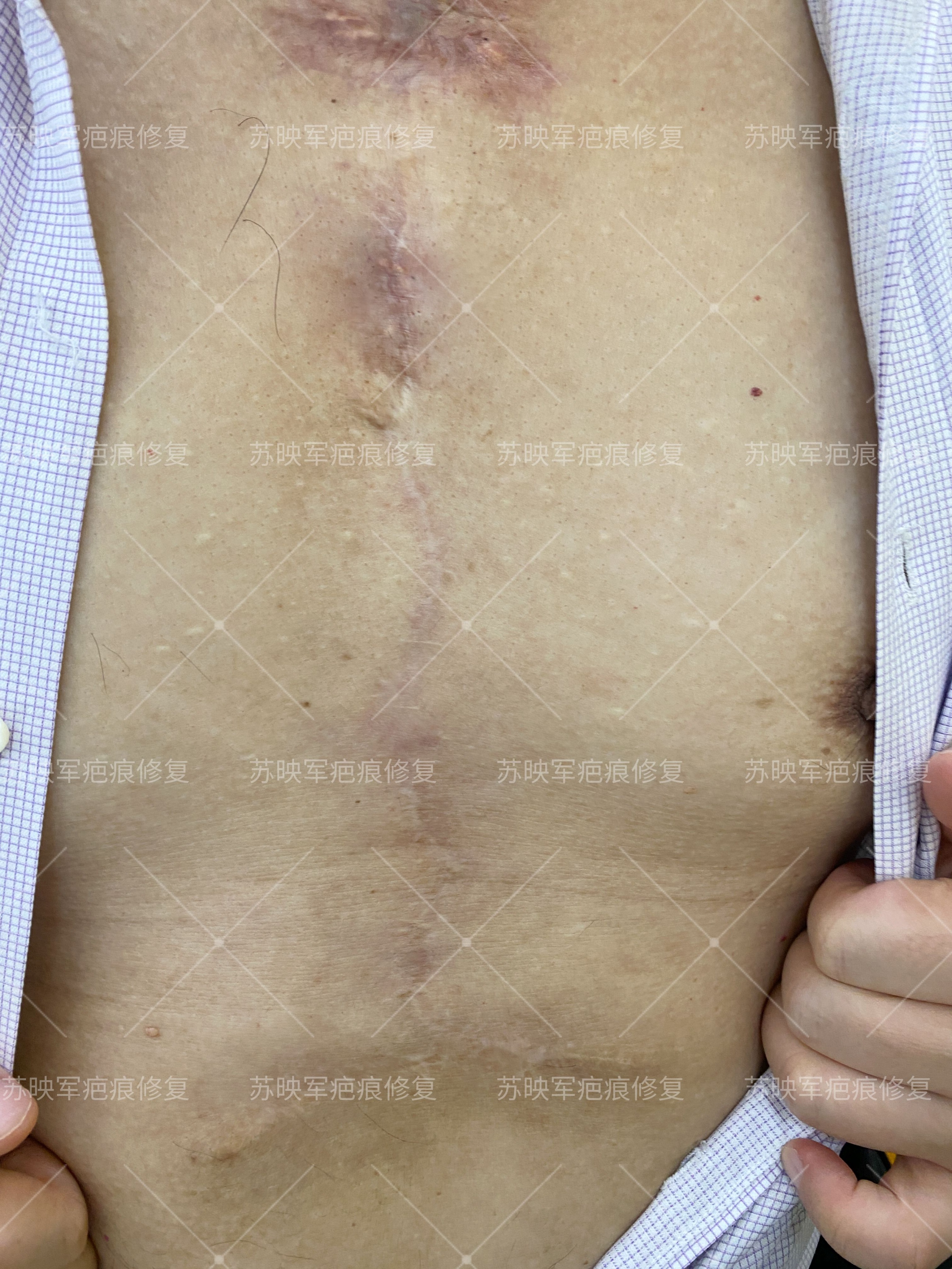 破溃流脓怎么处理,瘢痕疙瘩流脓切开引流