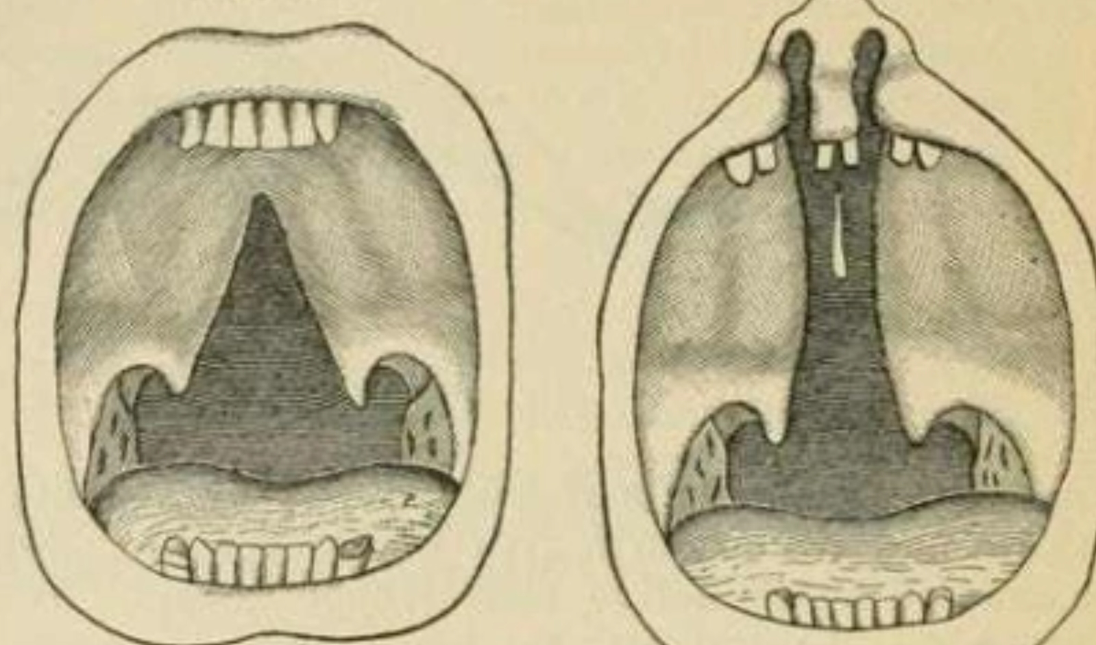 埃本拜尔斯为什么会反反复复发烧,埃本拜尔斯喝了几年