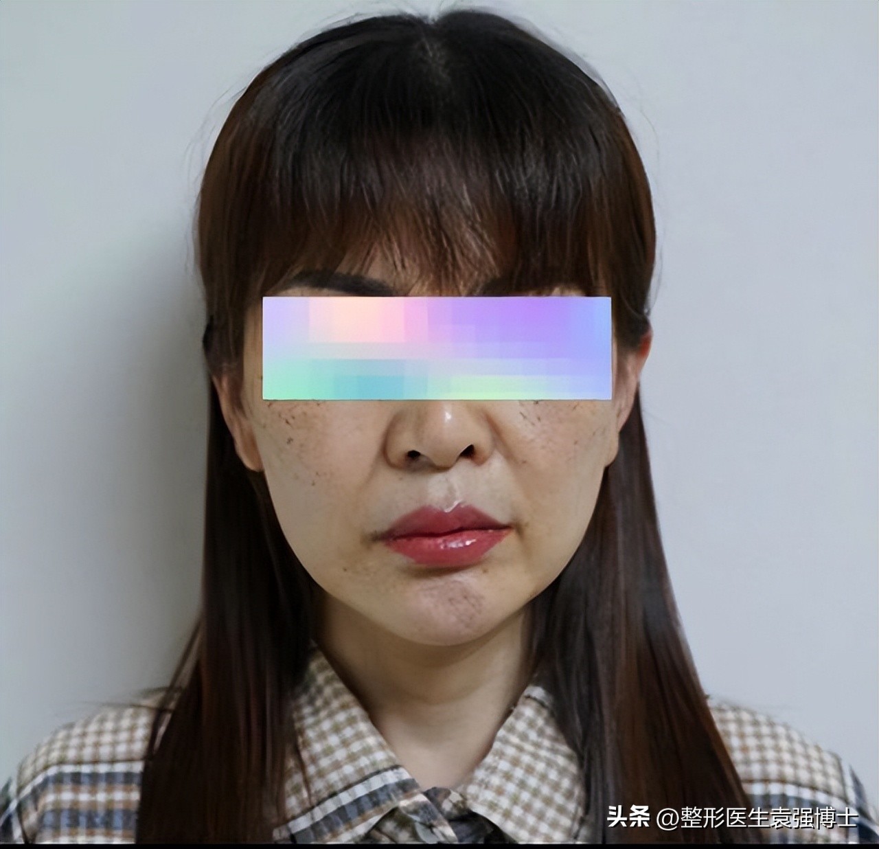 做拉皮手术会越来越薄吗,拉皮手术危险有真相