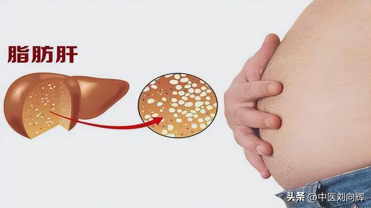 脂肪肝用哪种疏肝健脾药,脂肪肝配合什么药物