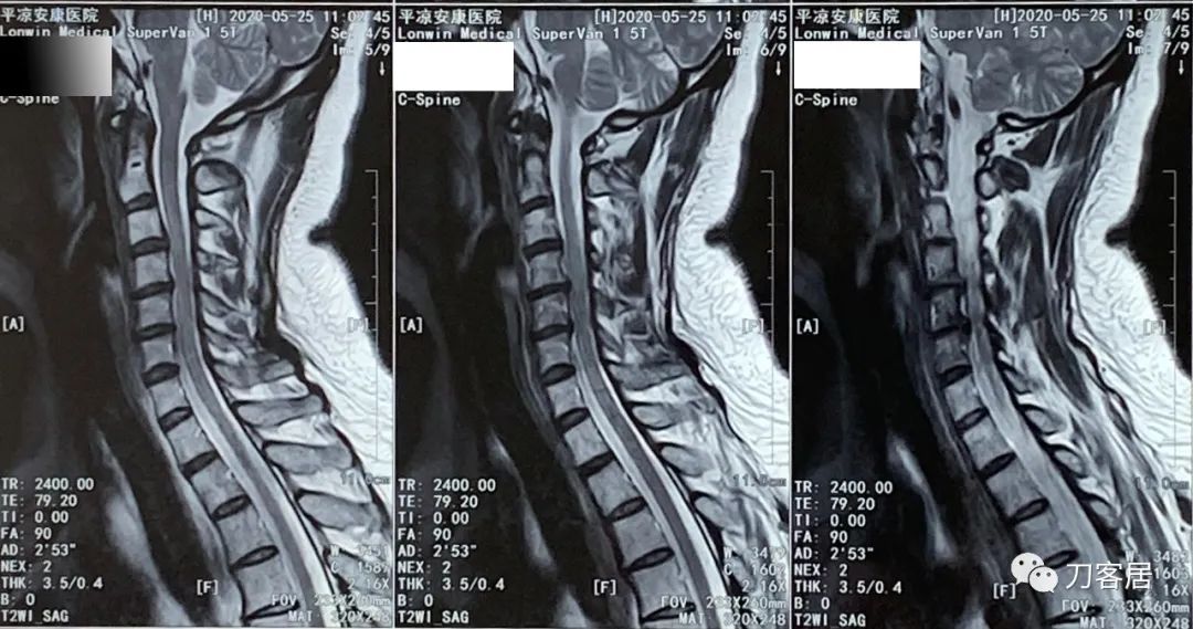 颈椎病十年了手臂酸痛肩背痛,颈椎病十年了一直痛怎么办