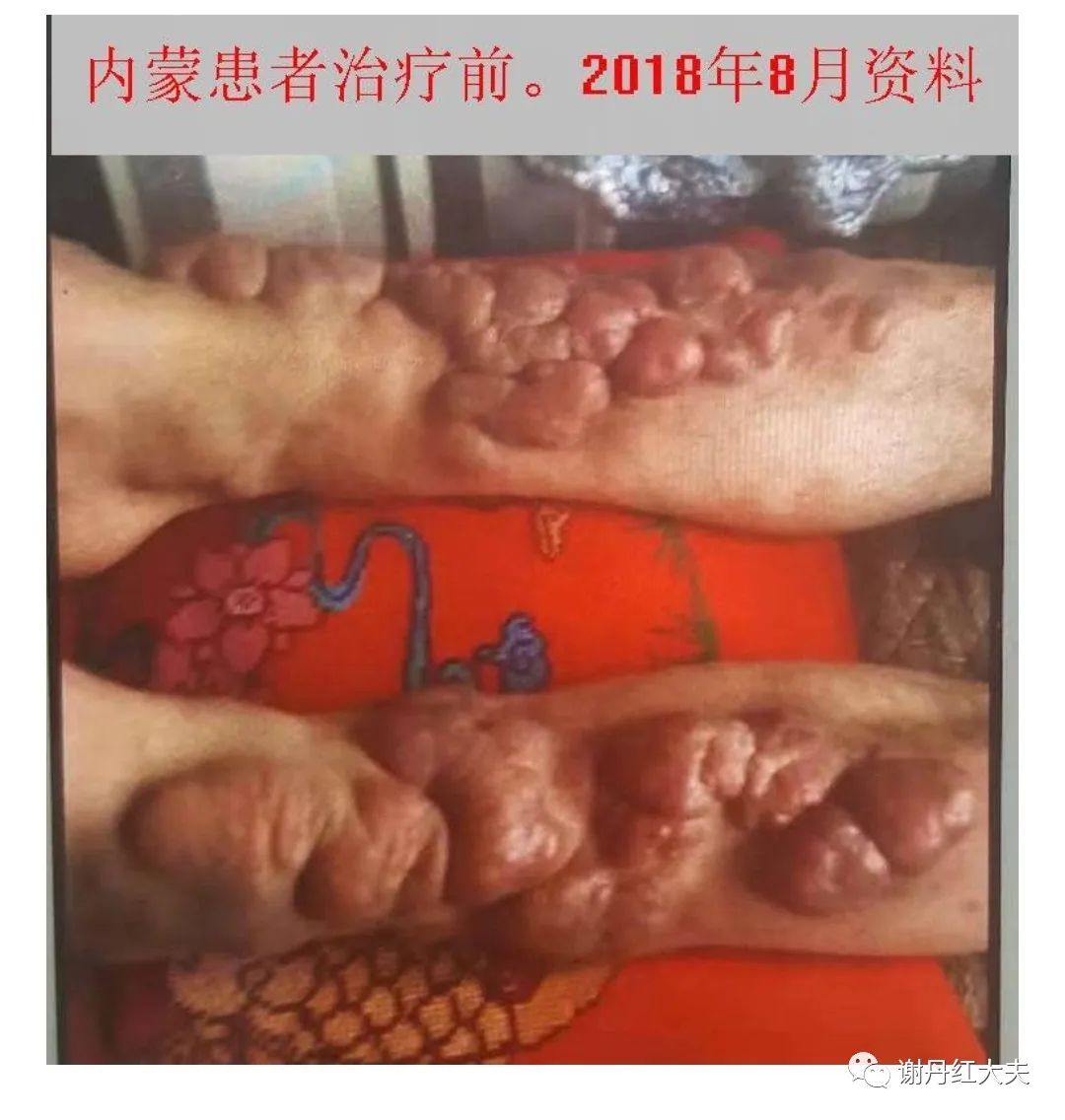 胫前黏液性水肿见于哪些病,胫前黏液性水肿为凹陷性水肿吗