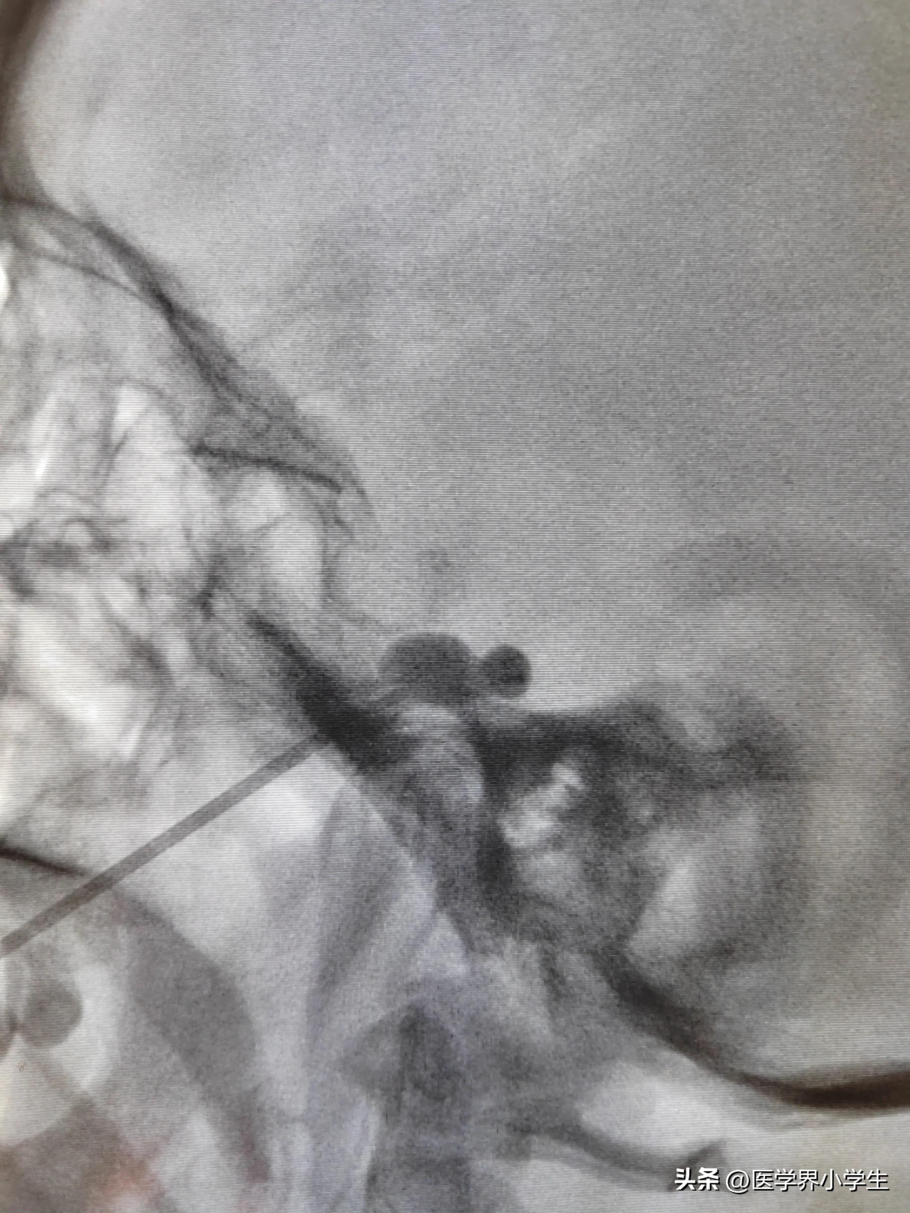 民间小偏方治三叉神经,三叉神经痛四个疗程能彻底治愈吗