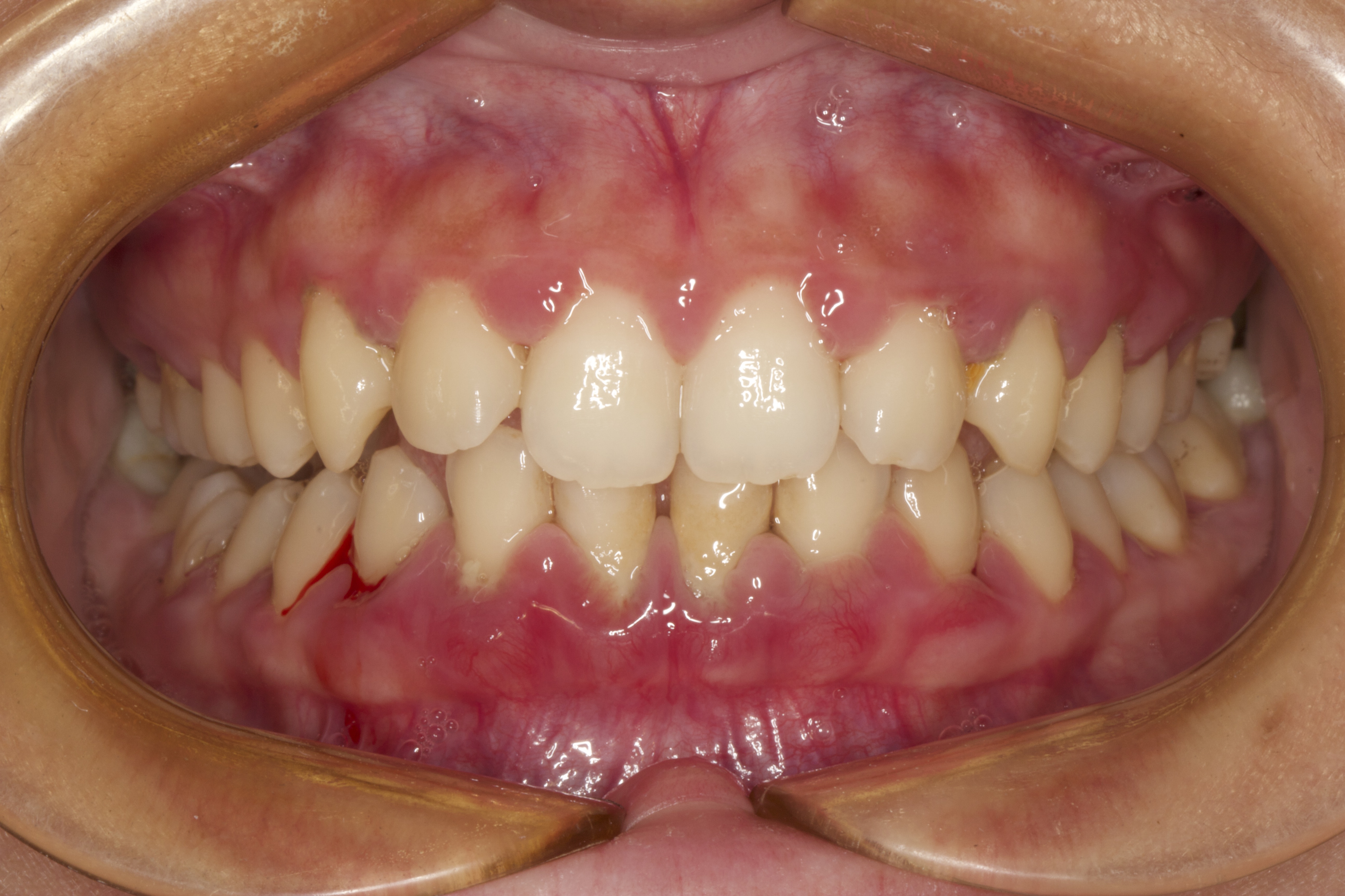 洗牙之后疼怎么办,洗牙疼不疼视频大全