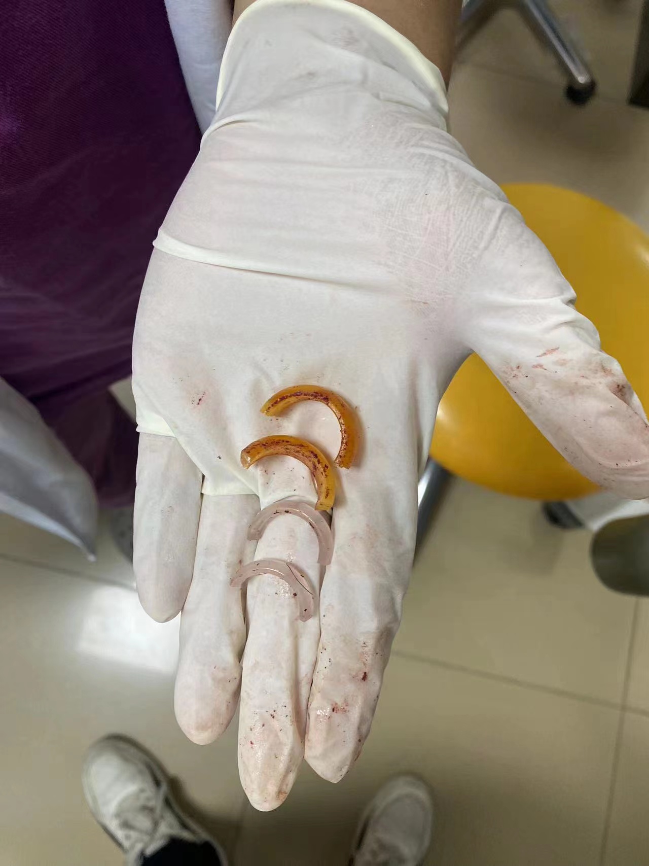 两枚戒指套牢六旬男子“命根子”，急救医生另辟蹊径巧妙取下