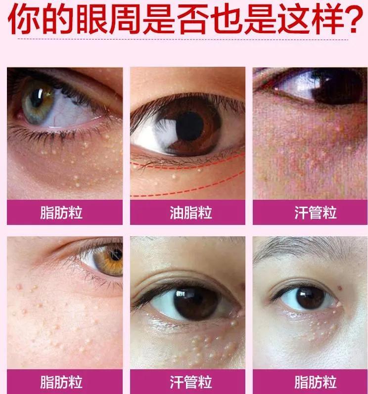 眼睛周围长小疙瘩是什么,眼睛周围长红米粒