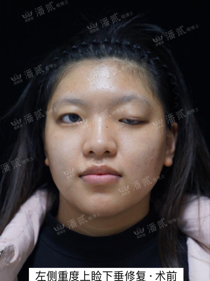 整形双眼皮术式好吗,眼部整形和双眼皮有什么区别