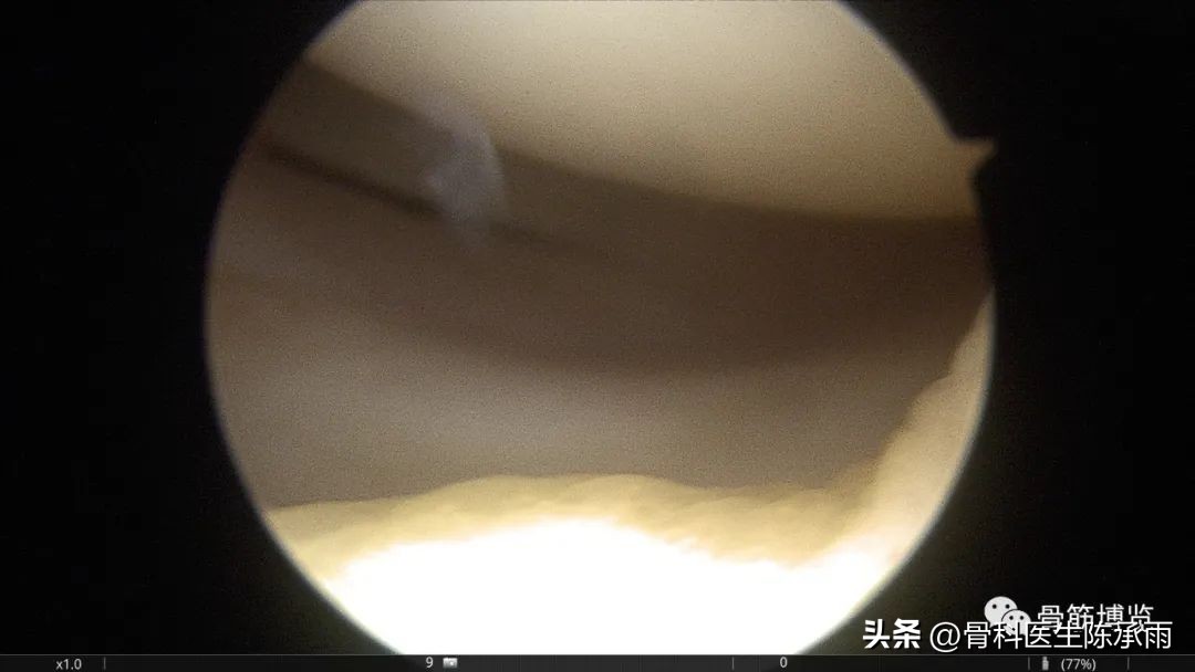 髌骨脱位软骨剥离怎么治疗,半月板撕裂游离体