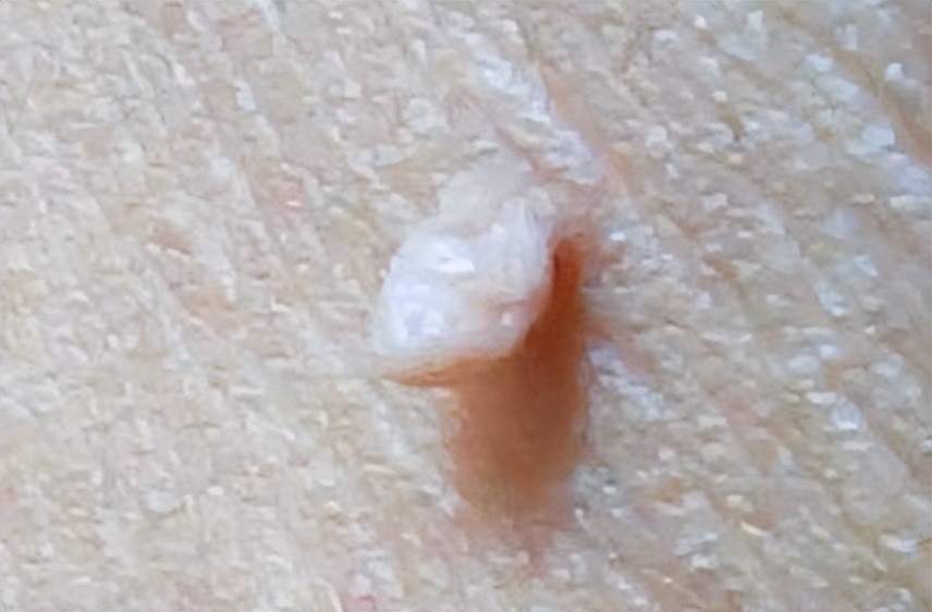 脖子腋下长小肉粒可以用手揪掉吗,脖子旁边出现小肉粒能直接揪掉吗