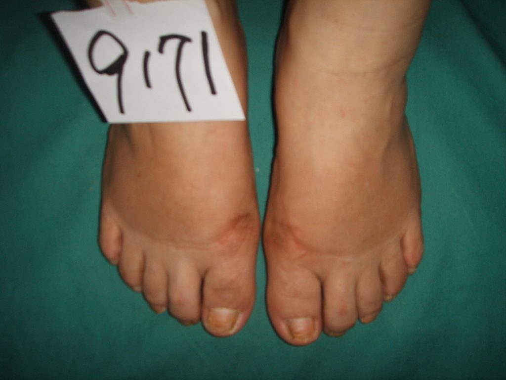 拇外翻疼痛怎么办,拇外翻疼痛的治疗方法药物