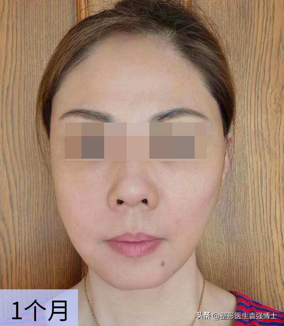 46岁肌肤松弛能做拉皮手术吗,46岁脸部下垂还能做拉皮手术吗