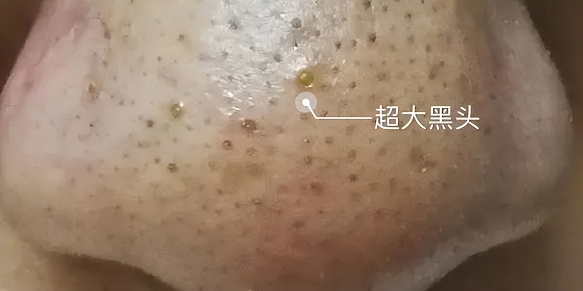 黑头没挤干净怎么办,黑头没及时处理变成黑痣了怎么办