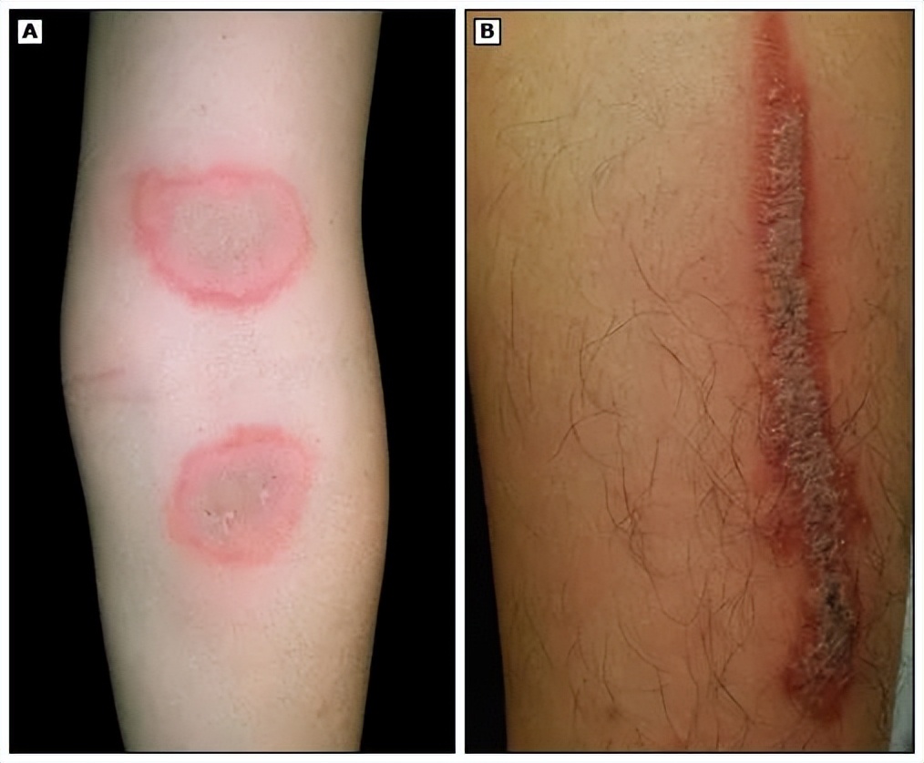 带娃出门游遇到蜱虫千万别乱拔,警惕这三种毒虫带娃出行必看