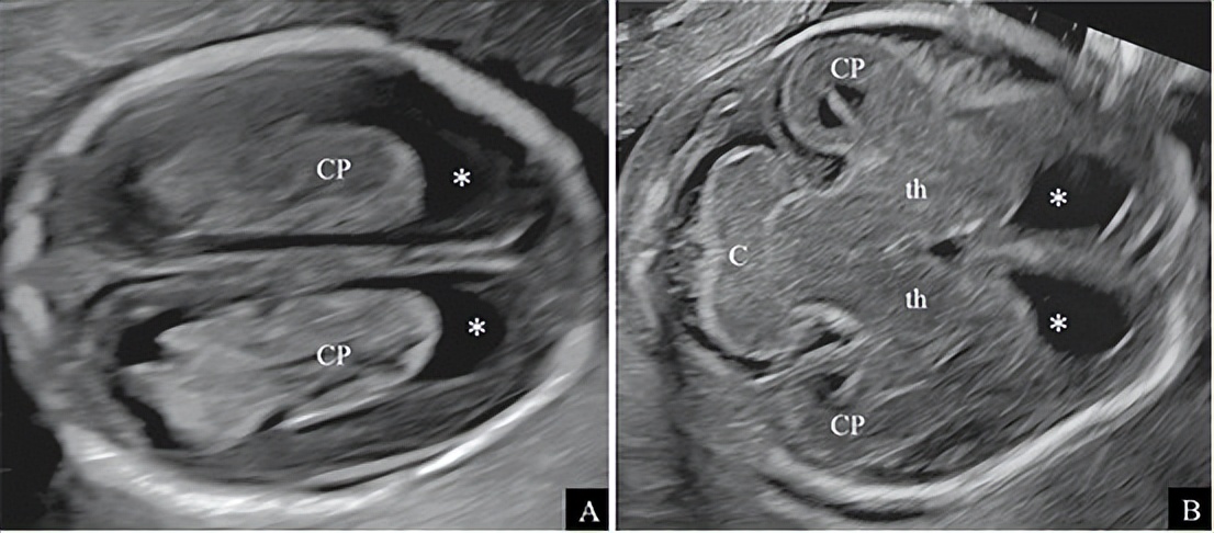 续:ISUOG实践指南(更新版):胎儿中枢神经系统超声检查(5)