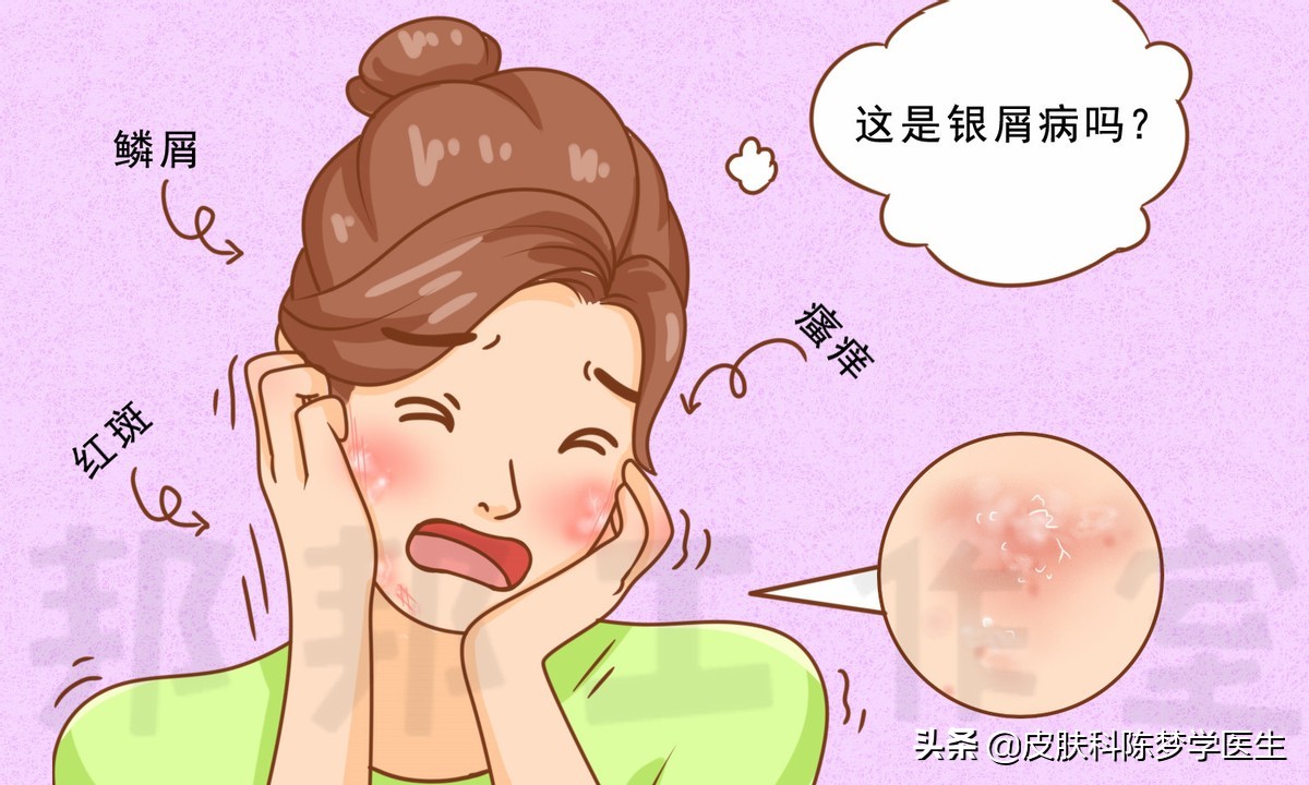 脸上银屑病引起的红斑突然严重,脂溢性皮炎脸上有一块块红斑