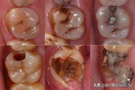 补牙太贵了？过来人表示：搞清楚2个门道后，能省不少