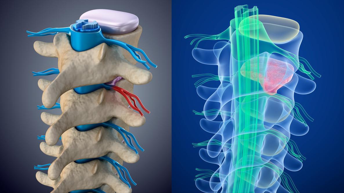 真正好的腰椎间盘突出治疗方法,腰椎间盘突出不做有效治疗的后果