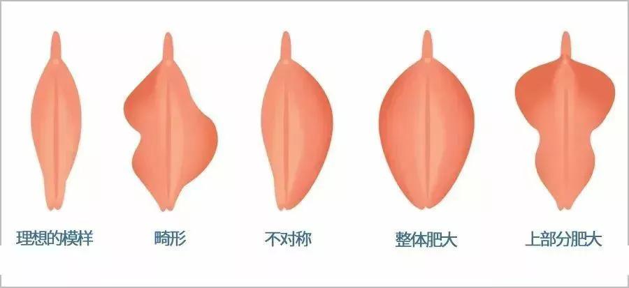 “私密整形”都包括哪些部位?