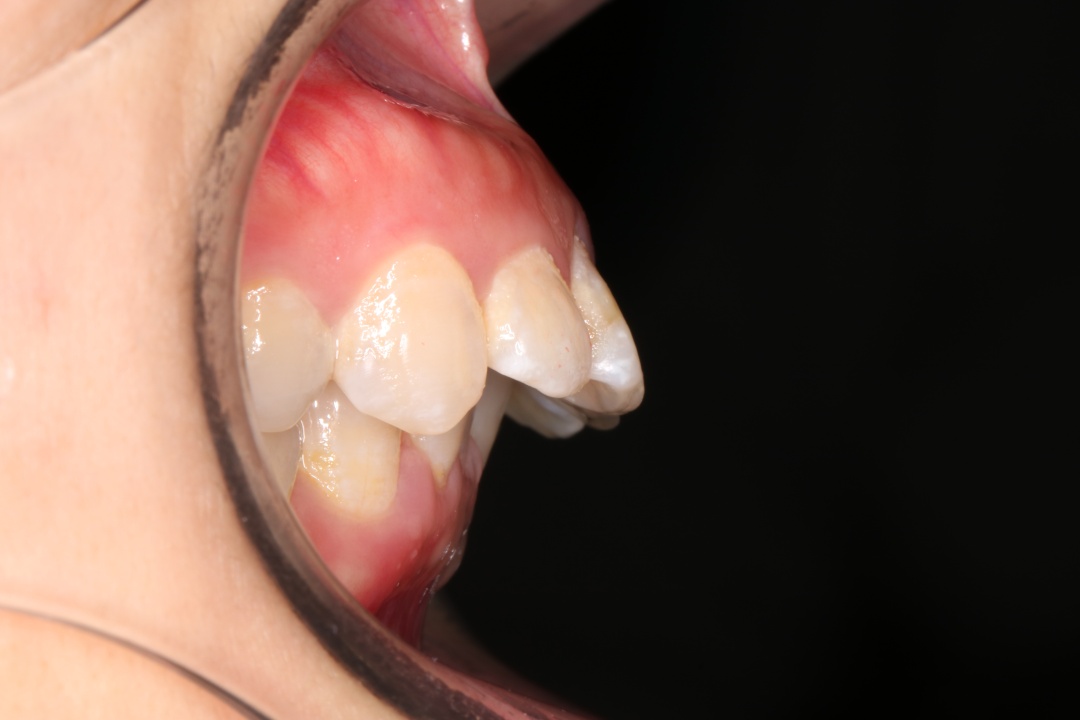 年龄越大凸嘴龅牙会不会越严重,年龄大了龅牙怎么办