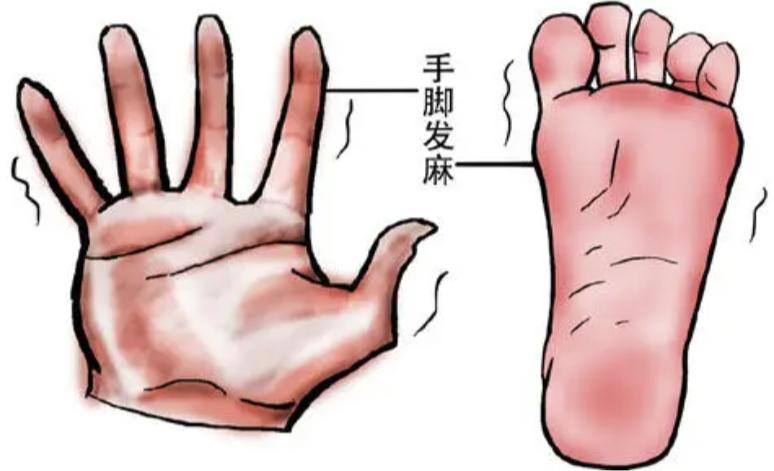 化疗手脚麻吃甲钴胺多长时间好,化疗后手脚麻木中药处方