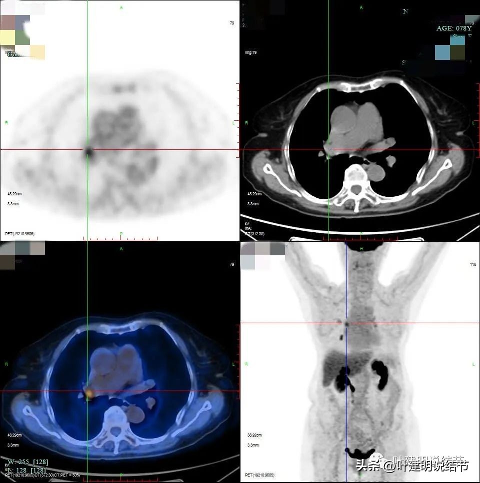 79岁肺癌早期手术风险,75岁早期浸润性肺癌还要治疗吗