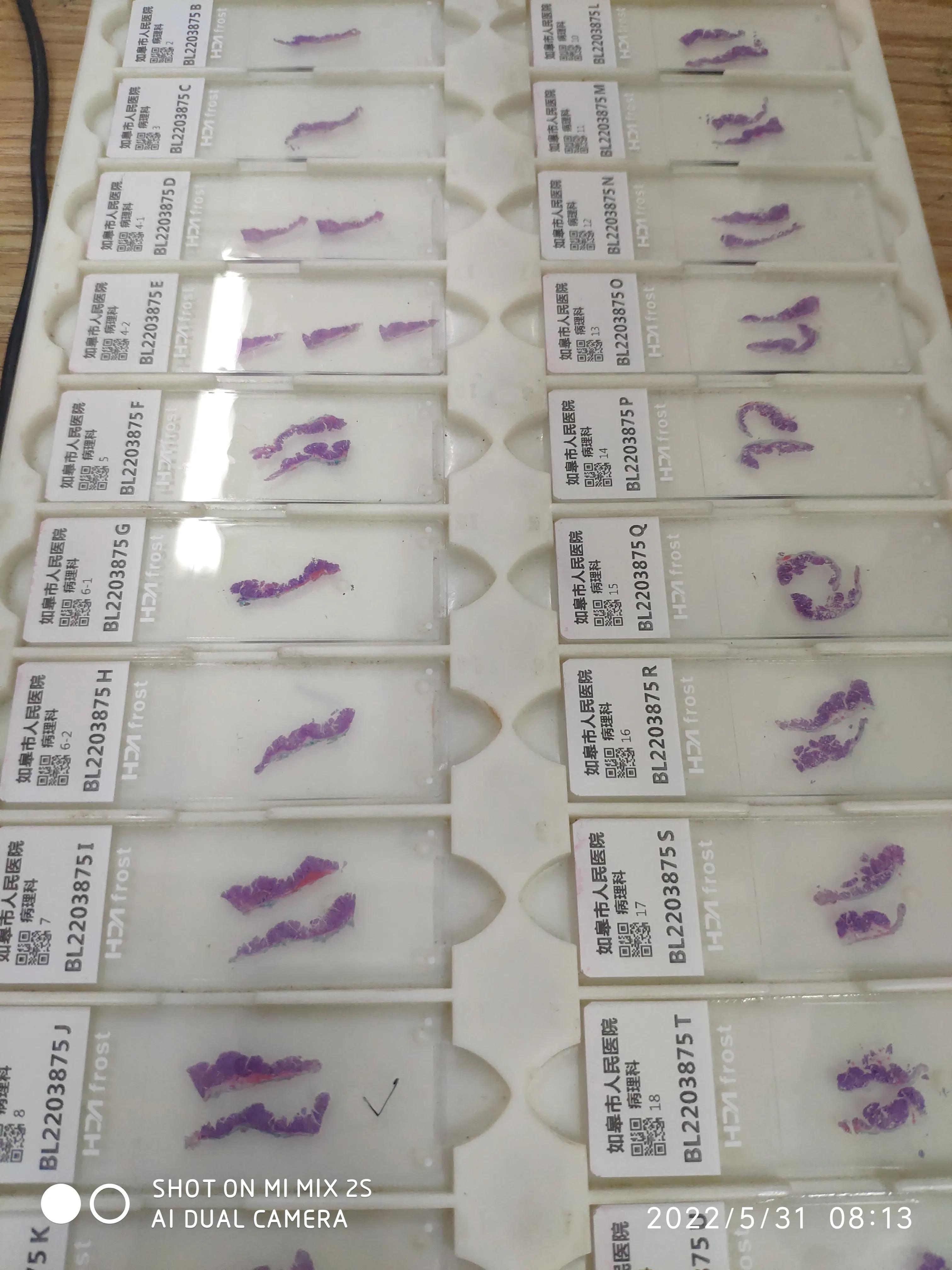 esd手术后续身体感觉,esd手术可靠吗