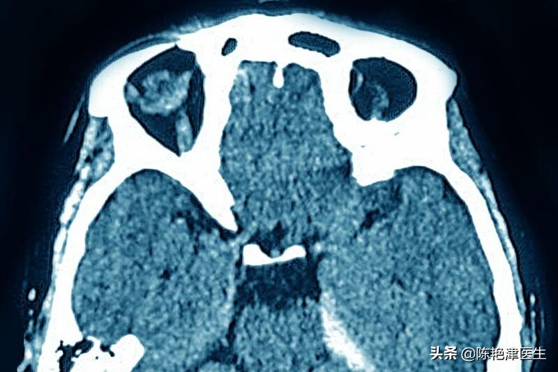 家人脑出血自己如何调整心情,家人脑出血了安全了怎么安慰