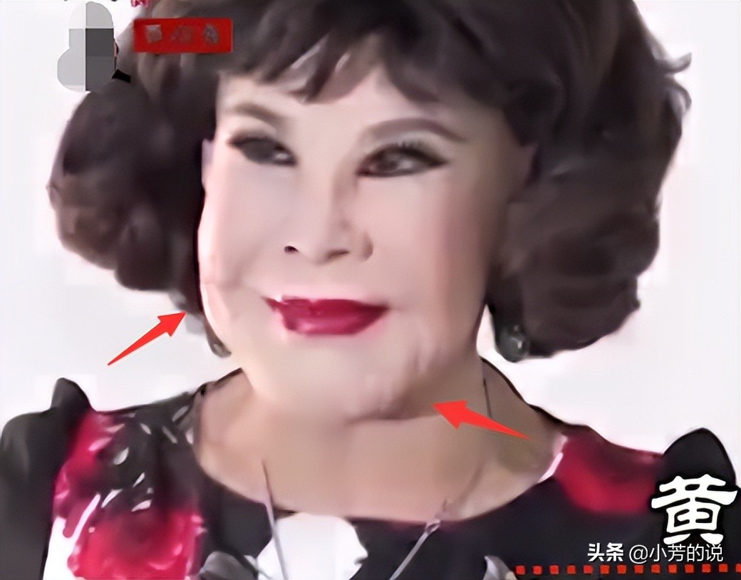 整容后出车祸假体外露,整容了被砸到脸会怎么样