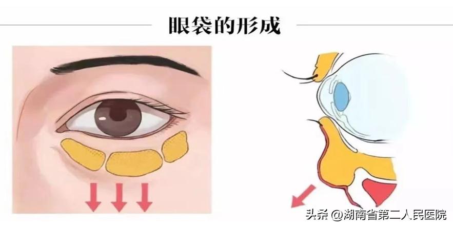 眼睛下面长了个小疙瘩可以切掉吗,眼睛长了个凸起的小包用手术吗