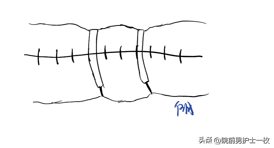 关于急诊清创缝合术必须掌握知识
