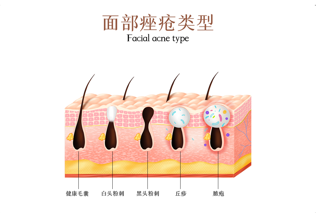 脸上长痘痘不挤能自己消吗,千万别乱挤脸上的痘痘