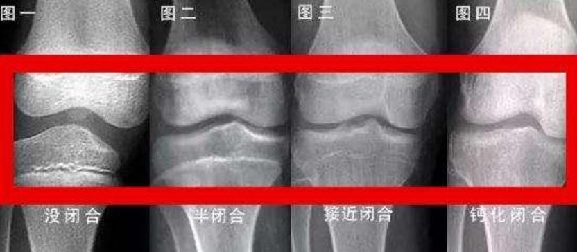 孩子骨骺线即将闭合的症状,孩子骨骺线闭合了吃什么药长得高