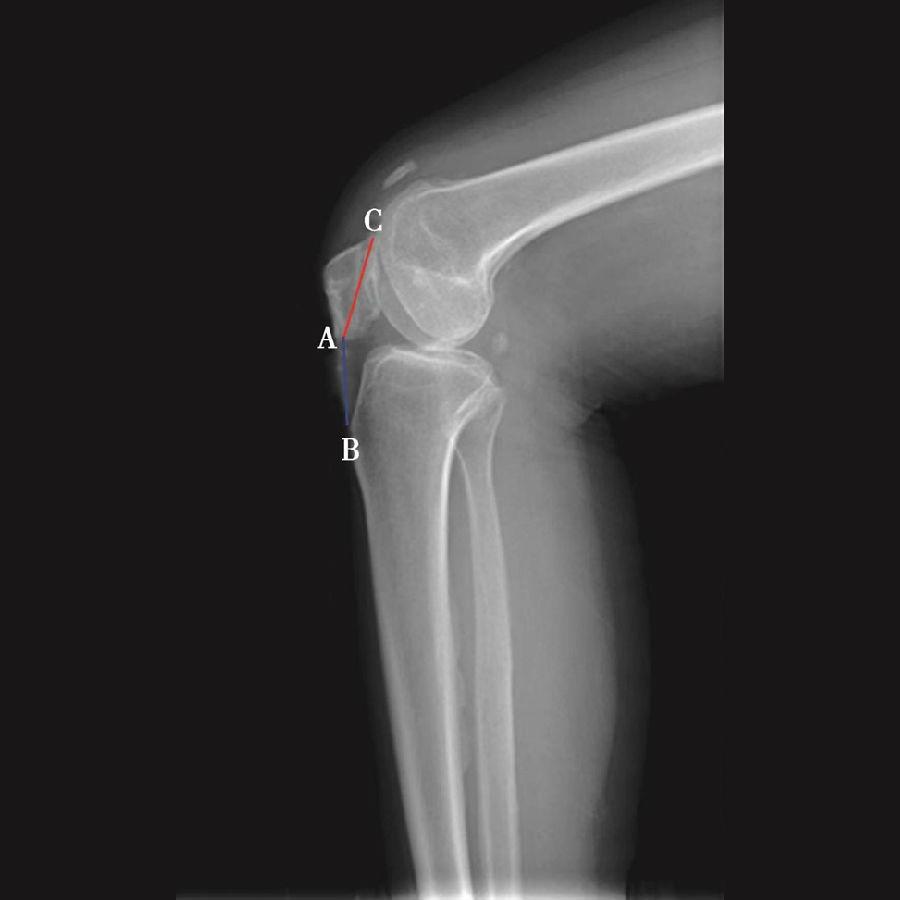 髌骨骨折评估,髌骨上下滑动评估什么内容