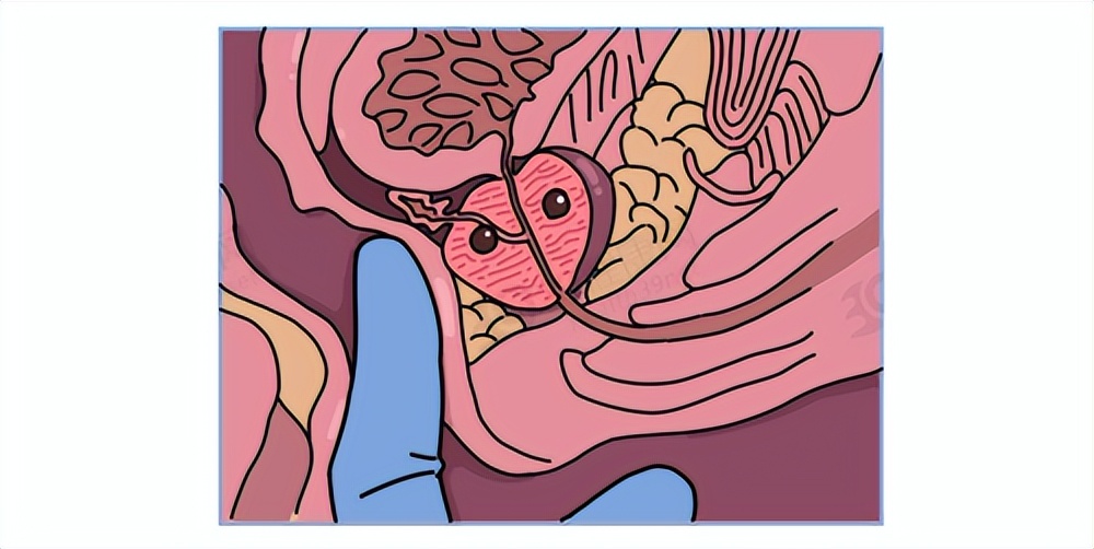 肠镜能区分痔疮和肠癌吗,肠癌血与痔疮血怎么区分