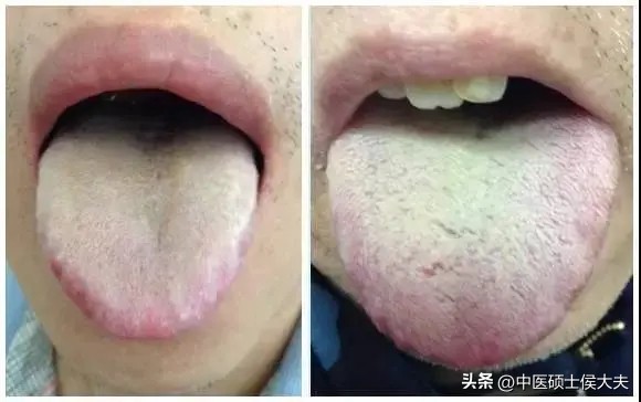 湿热肝郁脾虚按什么穴位,湿热脾虚肝火吃什么逍遥丸好