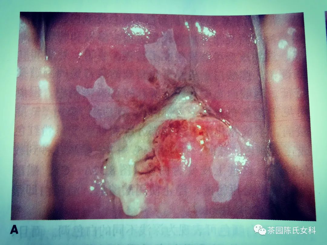 为什么看不孕都要先监测排卵,看不孕需要做宫腔镜检查吗