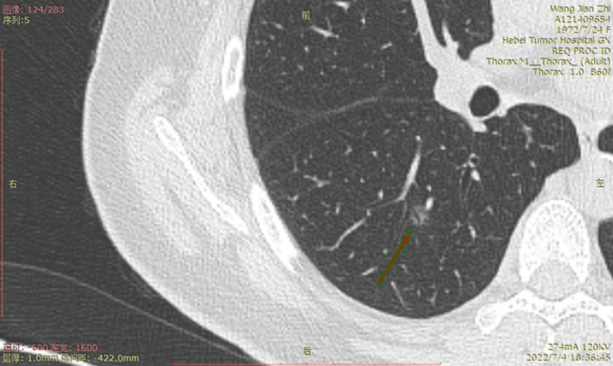首次发现磨玻璃结节要吃药消炎吗,磨玻璃结节警惕合并占位