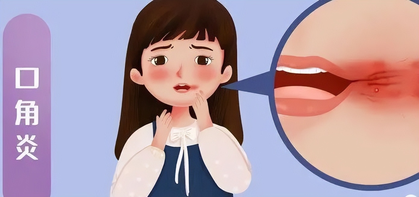 口角炎疾病如何用药？