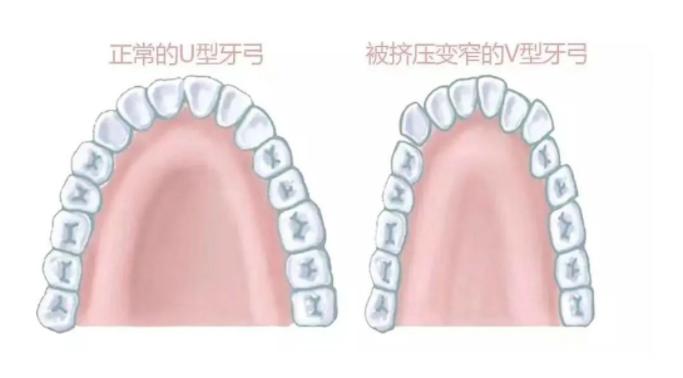年龄越大凸嘴龅牙会不会越严重,年龄大了龅牙怎么办