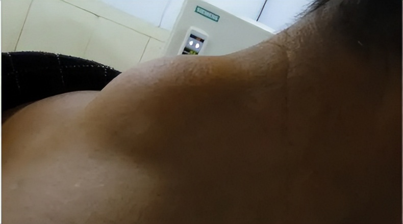 脂肪肉瘤和脂肪瘤摸着区别,脂肪瘤很常见吗