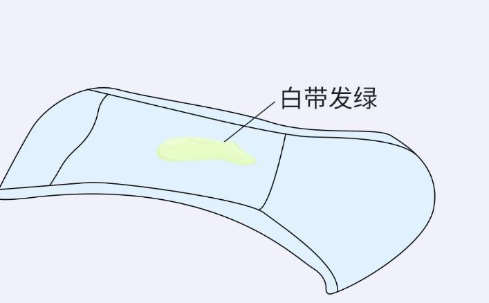 女性出现豆渣样白带是什么病,女性白带像豆渣一样是什么引起的