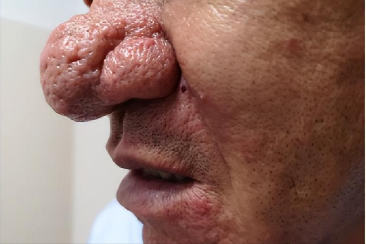 面部皮炎的症状和治疗方法,面部皮炎是怎么回事