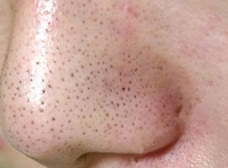 毛孔粗大黑头脸爱出油怎么解决,脸有黑头出油毛孔粗大怎么解决