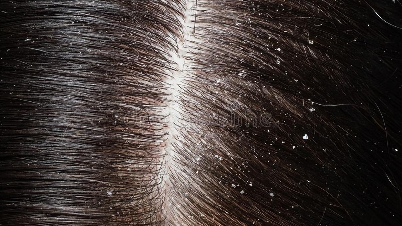 头皮屑多，真的是脑用过度吗？什么办法可以缓解？一次给你讲清楚