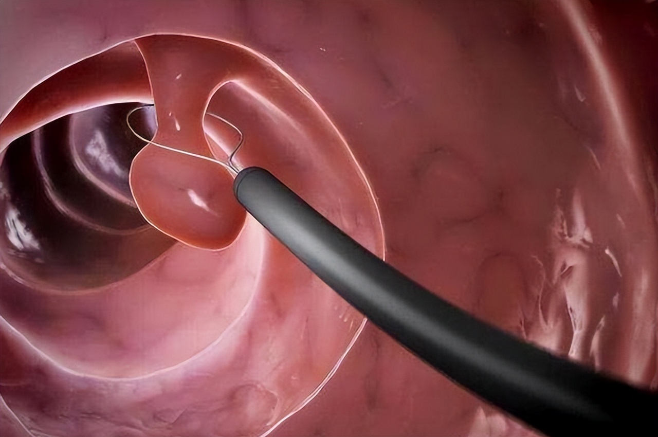 一次正常的肠镜可以确保多久,肠镜一次到底可以管多久