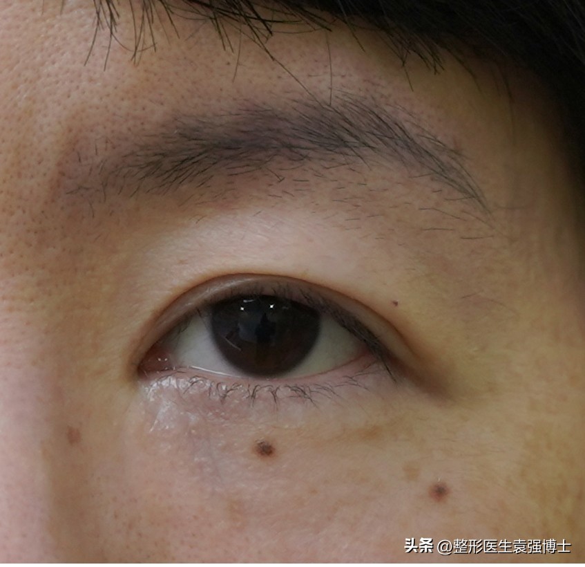 上眼皮松下垂该怎么办,上眼皮松弛耷拉怎么办