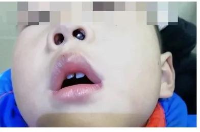 鼻出血介入治疗,鼻出血快速止血