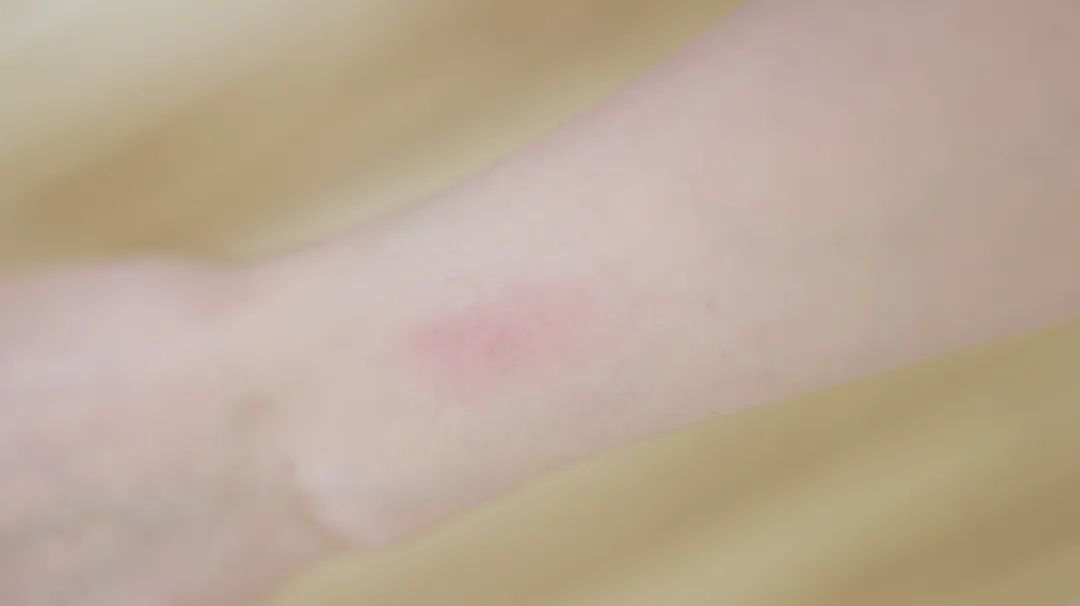 接触性皮炎包括哪些疾病,接触性皮炎出现什么症状算严重