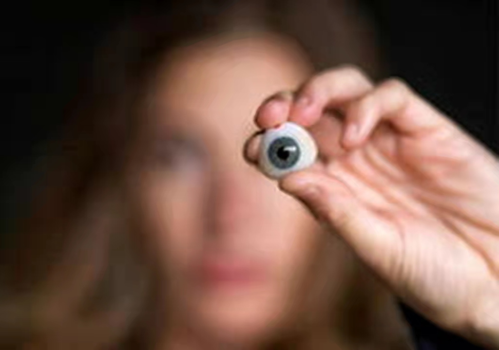 单眼上睑下垂恢复图,上眼睑下垂修复完大小眼明显