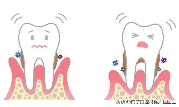 怎么治牙周病最好特别有效,牙医教你如何医牙